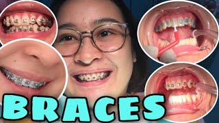 I GOT BRACES HOW TO PUT METAL BRACES ON TEETH PHILIPPINES 2021 [upl. by Bates]