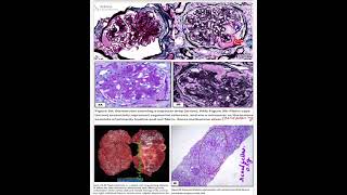 Diabetic Nephropathy part 2✅ kidney MORPHOLOGYRobbins 10th ed renalpath12 [upl. by Aytida]