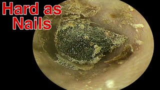 BIGGEST Ear Wax Difficult Removal  EP6  Doctor Anh [upl. by Chafee]