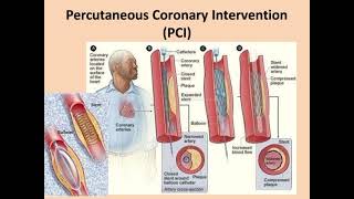 Atherosclerosis Angina Myocardial infarction✨ Full information💯 [upl. by Lindberg]