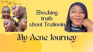 SHOCKING TRUTH ABOUT TRETINOIN  MY ACNE JOURNEY  PRODUCTS FOR ACNE [upl. by Audrye810]