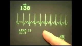 EKC ECG rhythms 1 Normal range of rhythms [upl. by Polish]