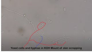 Yeast cells and hyphae in KOH Mount of skin scrapping [upl. by Hezekiah]