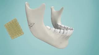 Resorbable Ceramic Biocomposites for Orthpaedic and Maxillofacial Applications [upl. by Elleron]