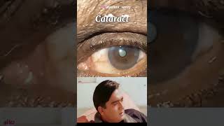 Bollywood song🥰 highlighting different eye condition cover wth song 🤣😂😅 [upl. by Limaa121]