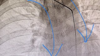 Taking A Deep Breath May Straighten The Right Subclavian ArteryAscending Aorta Curve [upl. by Burck]