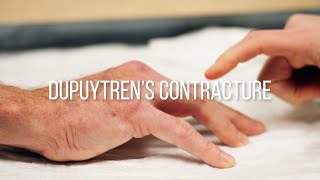 Dupuytrens Contracture Explained Symptoms Causes and Treatments [upl. by Griff]