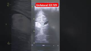 Cranial ultrasound in preterm neonate shows intraventricular hemorrhage G3 neonates hemorrhagic [upl. by Regdor]