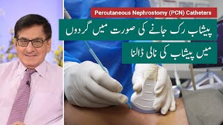 Percutaneous Nephrostomy PCN  گردوں میں پیشاب کی نالی ڈالنا [upl. by Klingel]