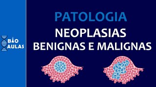 Neoplasias Benignas e Malignas  Características Nomenclatura e Diferenciação Patologia Geral [upl. by Lorianna547]