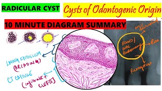 Radicular Cyst 10 MINUTE SUMMARY HISTOPATHOLOGY  Clinical features  Etiopathogenesis  Oral path [upl. by Asilehc433]