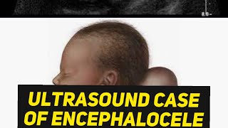 Encephalocele or Cystic Hygroma  Learn ultrasound [upl. by Roselyn]