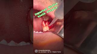 Surgical Removal of Impacted wisdom tooth shorts viralyoutubeshorts [upl. by Anaicul]