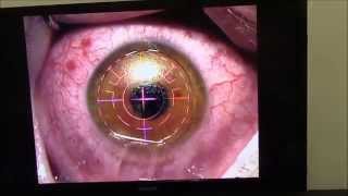 LASER EYE SURGERYTHE WHOLE PROCEDURE [upl. by Arihat]