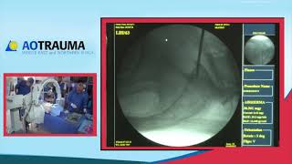 Percutaneous insertion of S1 iliosacral screw Mr Anthony Ward [upl. by Kilk]