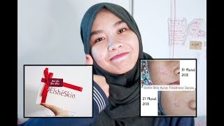 Kulit Jerawatan Review Pemakaian Elshe Skin Acne Treatment Series selama 2 bulan [upl. by Becki]