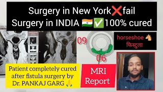 fistula surgery day 37patient completely cured after fistula surgery by dr pankaj gargfistulainano [upl. by Nylzzaj93]