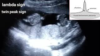 Dichorionic diamniotic twin pregnancylambda sign [upl. by Bel]