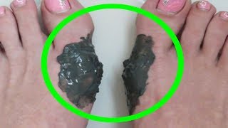 bunions how to treat bunions without surgery  get rid of bunions naturally without surgery [upl. by Goddard]