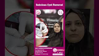 Sebaceous Cyst Removal  Dr Vimala Skin Hair amp Laser Centre sebciouscyst drvimala [upl. by Jemina]