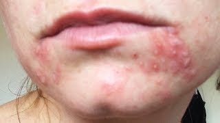 Dealing with Recurring Perioral Dermatitis [upl. by Anerak309]