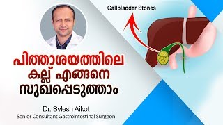 പിത്താശയക്കല്ലുകള്‍ ഒഴിവാക്കാം  Gallbladder Stone Treatment Malayalam Health Tips [upl. by Drews960]