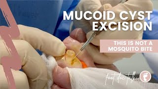 Mucoid Cyst Excision 👀 [upl. by Areema]