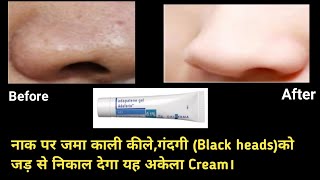 Adapalene gel Adaferin  01। कील और सफ़ेद दानों का इलाज Treatment for Blackheads amp Whiteheads [upl. by Ecyrb591]