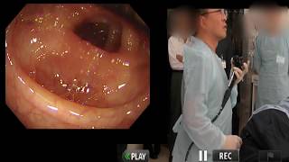 Live demonstrationcolonoscopy at AOMORI JAPAN2017Oct [upl. by Jeanie132]