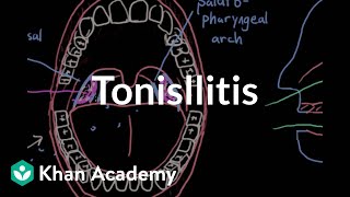 Tonsillitis  Respiratory system diseases  NCLEXRN  Khan Academy [upl. by Voe]