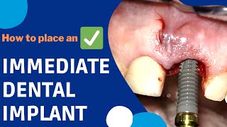 How is an IMMEDIATE DENTAL IMPLANT surgery done implants [upl. by Aihsilat]