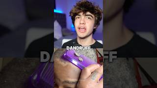 How to get rid of dandruff 😱🤝 [upl. by Namyl]