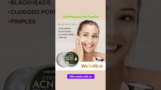 Wellution Cystic Acne Treatment face Cream howtolightendarkspots antiaging [upl. by Danielson]