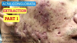 Mụn trứng cá mạch lươn nặngDermatologistpimpleswhitehead blackheadacne conglobata extraction 1 [upl. by Aiselad48]