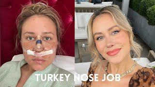 Rhinoplasty in Turkey  Nose Job VLOG [upl. by Gefen]