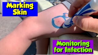 Outlining Insect Bites  Monitoring for Skin Infection  Nursing Skills [upl. by Ebbie]