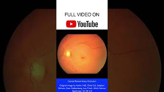 Central Retinal Artery Occlusion Fundoscopy shorts [upl. by Aicram]