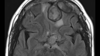 Intracranial Granulomatous Reaction [upl. by Forrest]