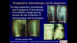 Strategy of treatment of osteosarcoma [upl. by Bromleigh637]