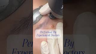 Laser Mole Removal Singapore [upl. by Noemi]