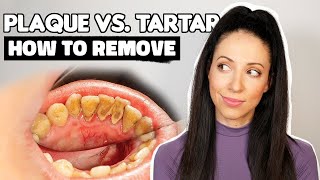 Plaque vs Tartar  How To Remove Plaque From Teeth [upl. by Inaluahek]