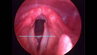 PÓLIPO DE CUERDA VOCAL  HEMORRHAGIC VOCAL FOLD POLYP [upl. by Ocirred640]