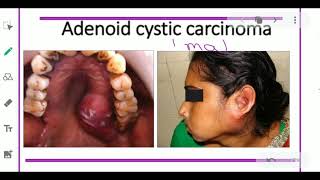 ADENOID CYSTIC CARCINOMA  ORAL PATHOLOGY SALIVARY GLAND TUMOR [upl. by Wilkins393]