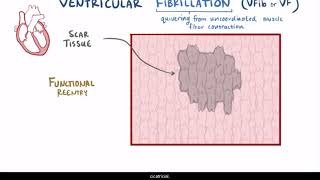 Fibrilación ventricular [upl. by Enale]