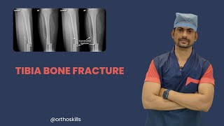 Tibia Bone FractureTibia Bone Fracture typesTibia Bone Fracture kya h [upl. by Chastain]