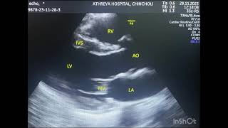 2D Echo and Cardiac Doppler [upl. by Haeli]