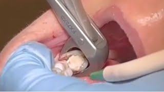 Extraction of Lower second Molar [upl. by Yaeger]