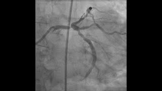 Left main PCI for distal lesion with caliber mismatch [upl. by Yekcor445]