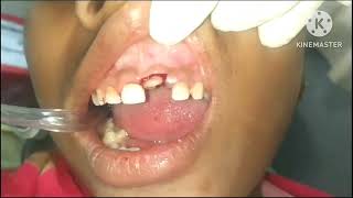 Crown Lengthing and Tooth build up by Post core [upl. by Tema]