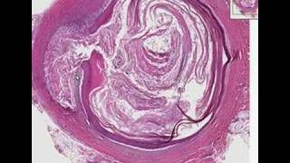 Histopathology SkinEpidermal inclusion cyst [upl. by Eilram674]